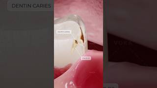 What is dental caries and how does it develop? Explore dentistry in 3D