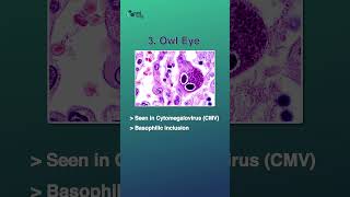 Pathology Concepts Simplified | Must-Know Topic for FMGE & NEET-PG
