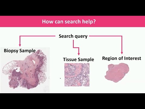 AI, Digital Pathology and Observer Variability: From Image Search to Building Diagnostic Consensus