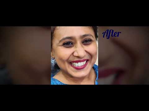 Teeth Whitening in dental clinic II Office Bleaching II