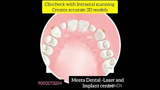 Intraoral scanning for aligners #chennaidentist #dentist #dentalclinic #dentistry