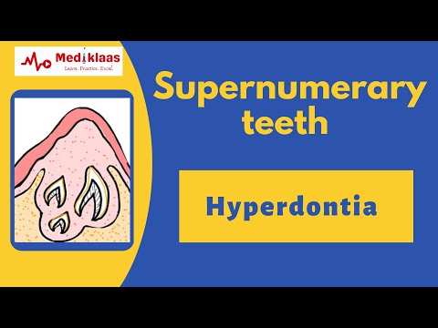 Supernumerary Teeth l Hyperdontia l Developmental disturbance of teeth l Mediklaas