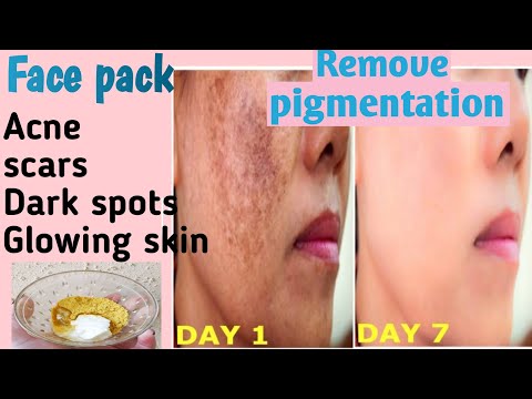 How to remove pigmentation at home|| remove dark spots|| best face pack|| beauty tips