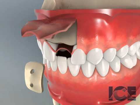 Bone Graft