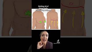 Getting rid of upper belly fat in Top Surgery #genderaffirmingcare #doctor #ftm