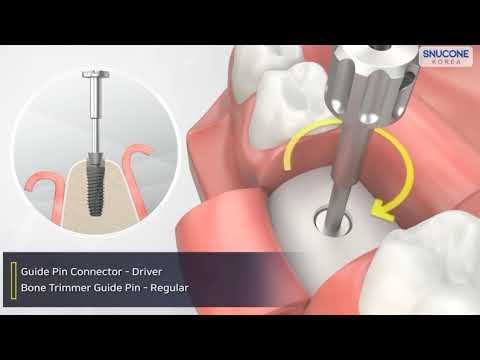 Snucone Bone profile kit #abutment #healing abutment
