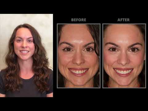 Transform your smile with perfect veneers!
