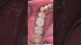 Same-day inlay or almost onlay restoration on an endo treated tooth #biomimetic #dentistry #dentist
