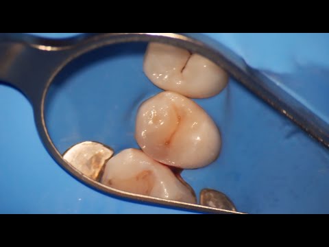 Class Two Composite Restoration Upper Second Premolar