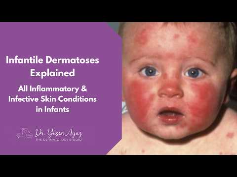Lecture 1: Infantile Dermatoses Explained | All Inflammatory & Infective Skin Conditions in Infants