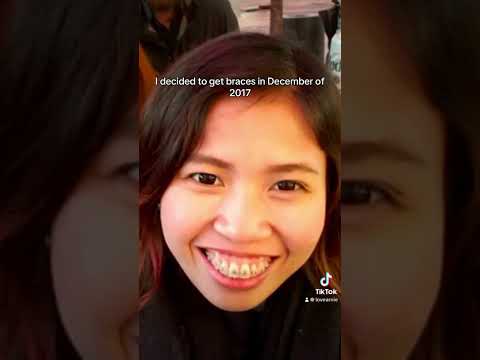My 7yrs of dental braces journey | Finally metal-free | overbite | better smile  | Pinas | #wfhmom