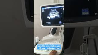 Variable presentation usg 16 wks....#shorts #viral #youtube