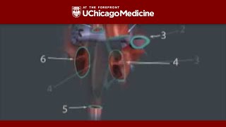 Animation of a Total Heart Transplant