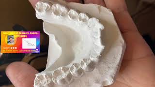 Treating Simple Orthodontic Case! Digital Impression