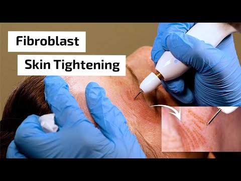 What is Fibroblast Skin Tightening? | Prime Plasma