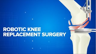 Robotic Knee Replacement Surgery