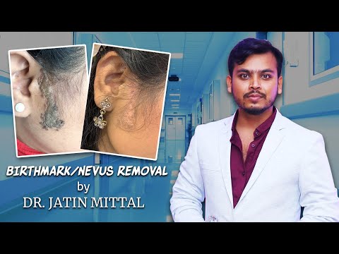Birthmark/nevus removal ||  Dr Jatin