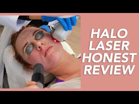 My Halo Laser Experience: Honest Review, Recovery, and Before & Afters!