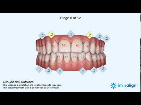 Invisalign Transformation
