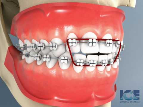 Anterior Openbite Braces