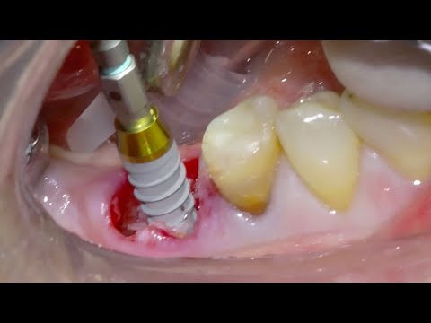 Immediate Implant placement with Versah® Burs - Mandibular 1st Molar
