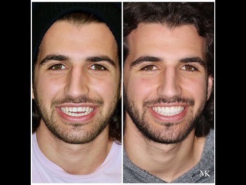 How I Finally Learned to Love my Smile