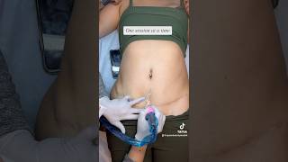 Cosmetic tattoo, Scar Camouflage #fypyoutube #fypage #costmet #cosmetictattoo