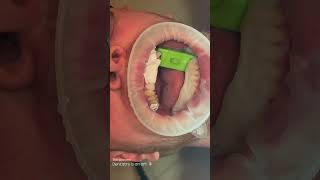 The art of dentistry 👏🏼 #cosmetics #dentist #3dprinting #liverpool #manchester #teeth #veneers
