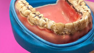 Professional Teeth Cleaning: Plaque and Tartar Removal Explained