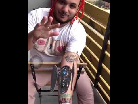 Nessly’s Antares Auto-Tune Arm Implant