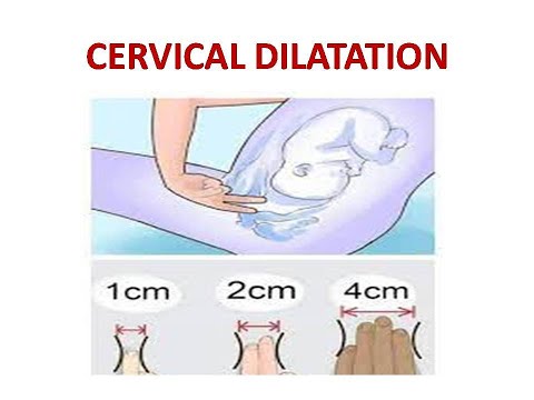 CERVICAL DILATATION