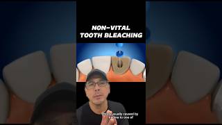 Restoring Color of Dead Tooth After Trauma | View Mobile Dental #shorts