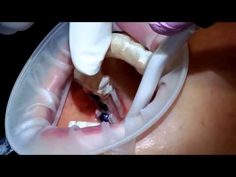 Dr. Joo Kwon - Restoring previously failed implants.