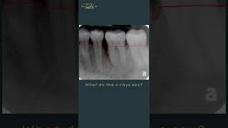 Deep Cleanings? Why do you need one and what do we look for when recommending one? #dentistry