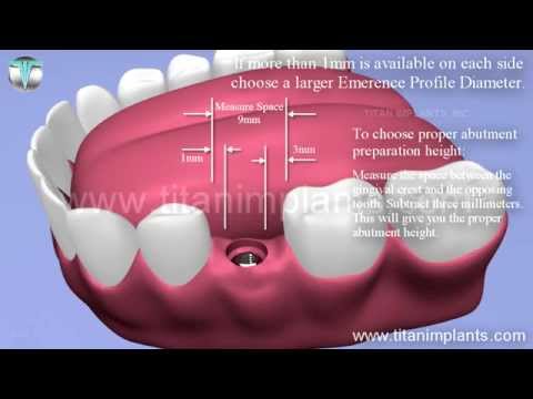 Close Tray Impression Technique Using Simple Step Abutments