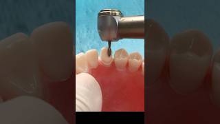 Crown preparation - Canine #teeth #teethstreet #dentalprocedure #dental