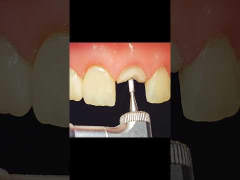 Tooth With No Hope... Rebuilt Completely