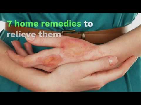 Burns in the fingers 7 home remedies to relieve them
