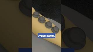 Myofascial Cupping for Pain Relief: Types & pre treatment routine
