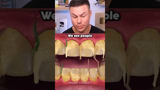 Drake's Teeth Are Disgusting!