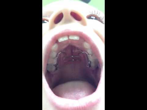 Palatal Expander: Getting Braces On: Nirenblatt Orthodontics