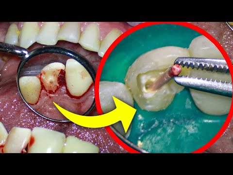 Root Canal Filling and Nerve Removal