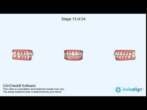 Tooth Movement with Invisalign