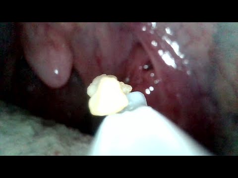 Tonsil Stone Removal | AIM 1
