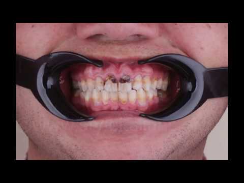 Single visit smile transformation using compoSite veneers