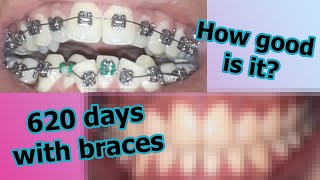 Braces Time-lapse | 620 days wearing braces