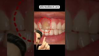 individual upper front tooth discoloration! Dentist reacts #teethwhiteningtips #teethwhiteningremedy