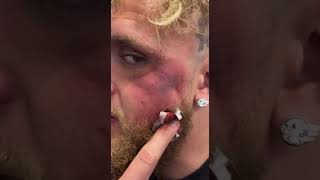 Jake Paul’s Jaw is Recovering ❤️‍🩹 #jakepaul #boxing #viral #funny