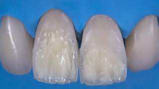 Direct restoration of frontal teeth (Viral in USA)