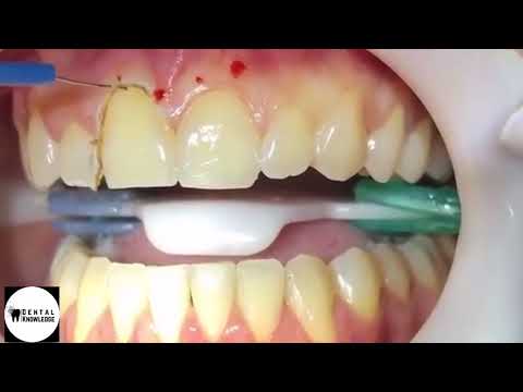 Gum correction by surgery